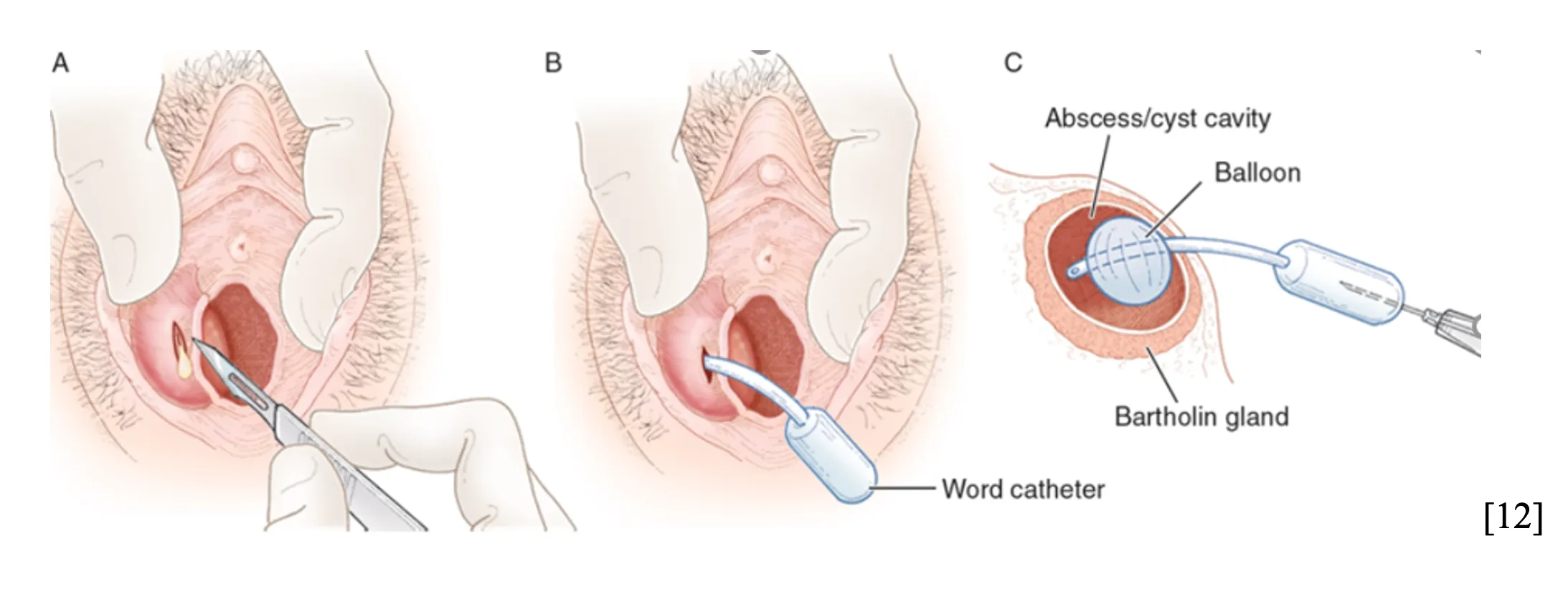 Bơm bóng giữ catheter