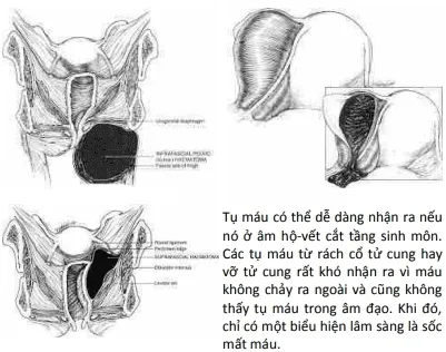 Các tụ máu