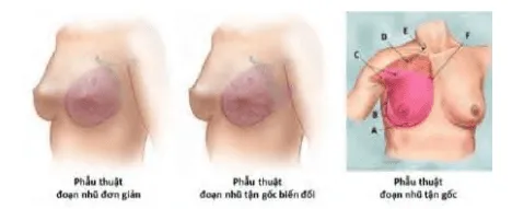 Đoạn nhũ