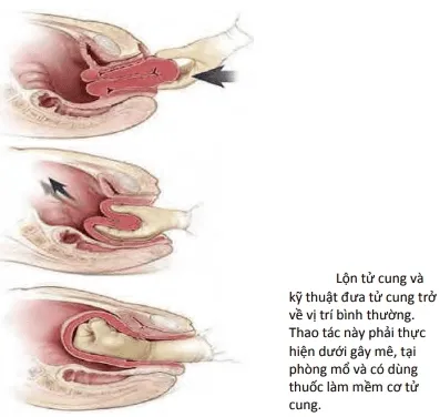 Lộn tử cung và kỹ thuật đưa tử cung về bình thường