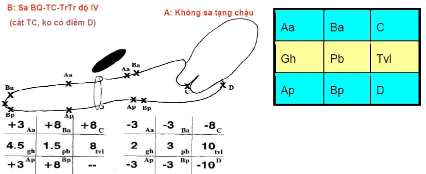 Sơ đồ chẩn đoán sa tạng chậu