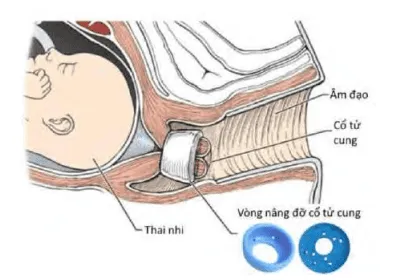 Vòng nâng cổ tử cung